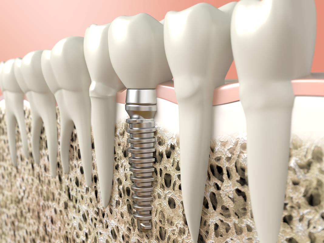 Dental Implants  Plantation, FL 